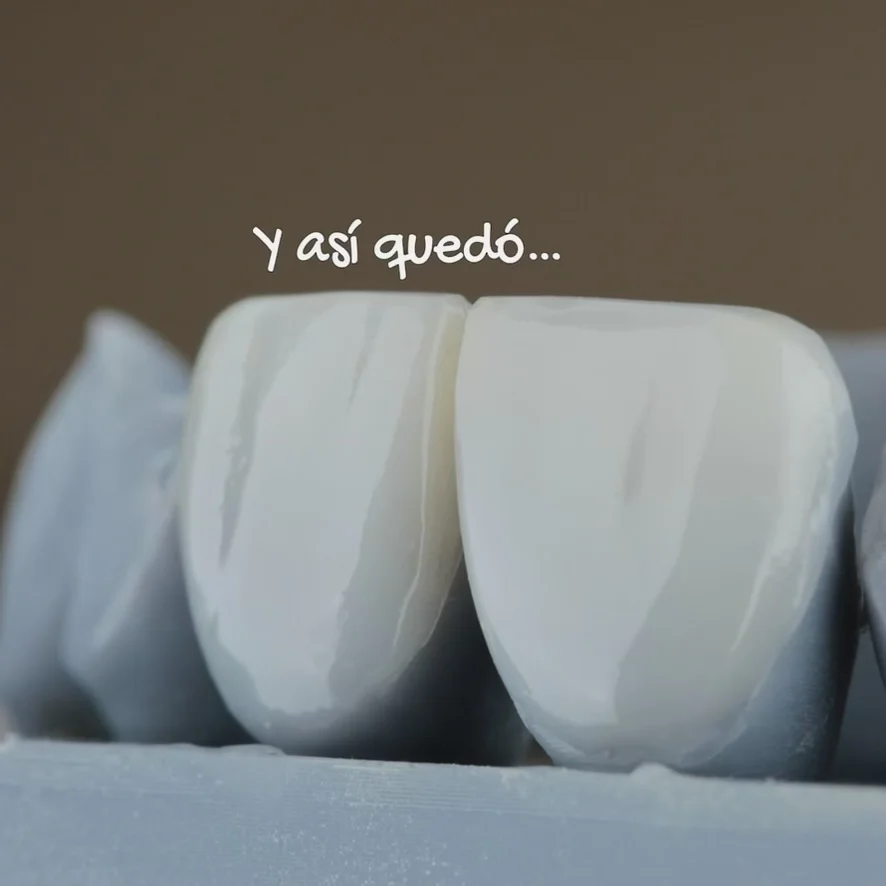 Carillas dentales y diseño de sonrisa en Veracruz con planeación digital