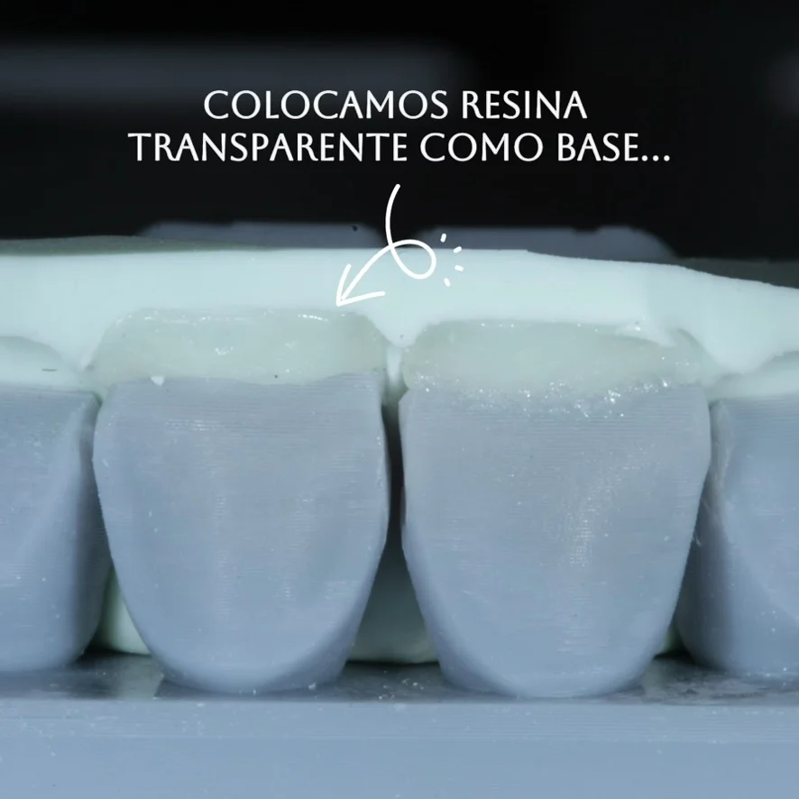 Diseño de sonrisa paso 5