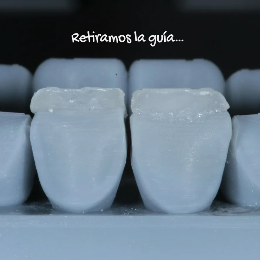 Bordes incisales translucidos en carillas dentales