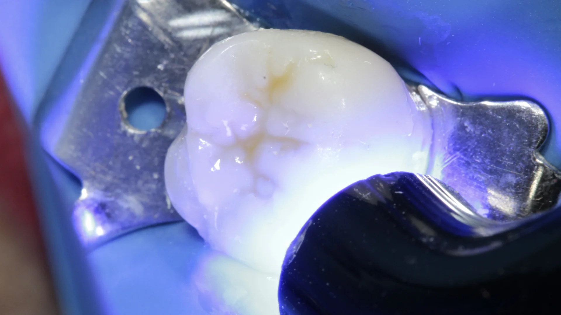 Resina dental - Caso 2l