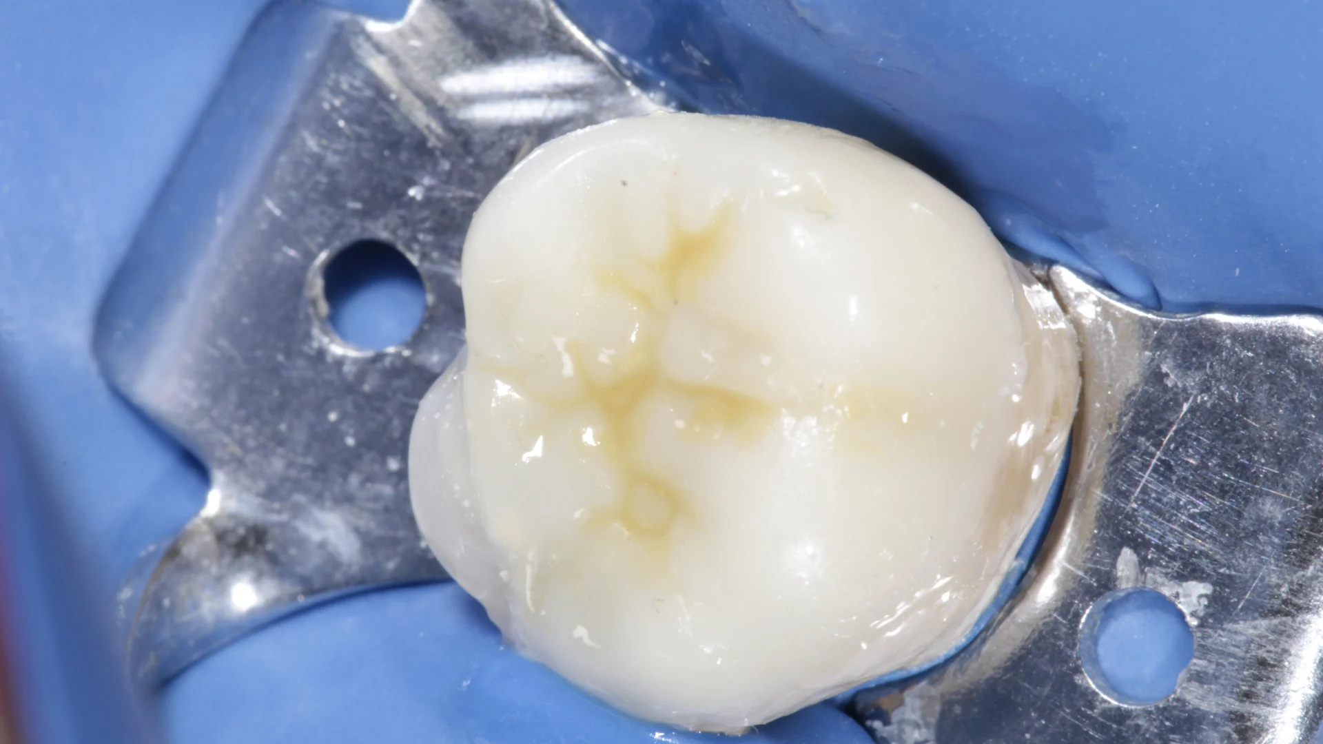 Resina dental - Caso 2n