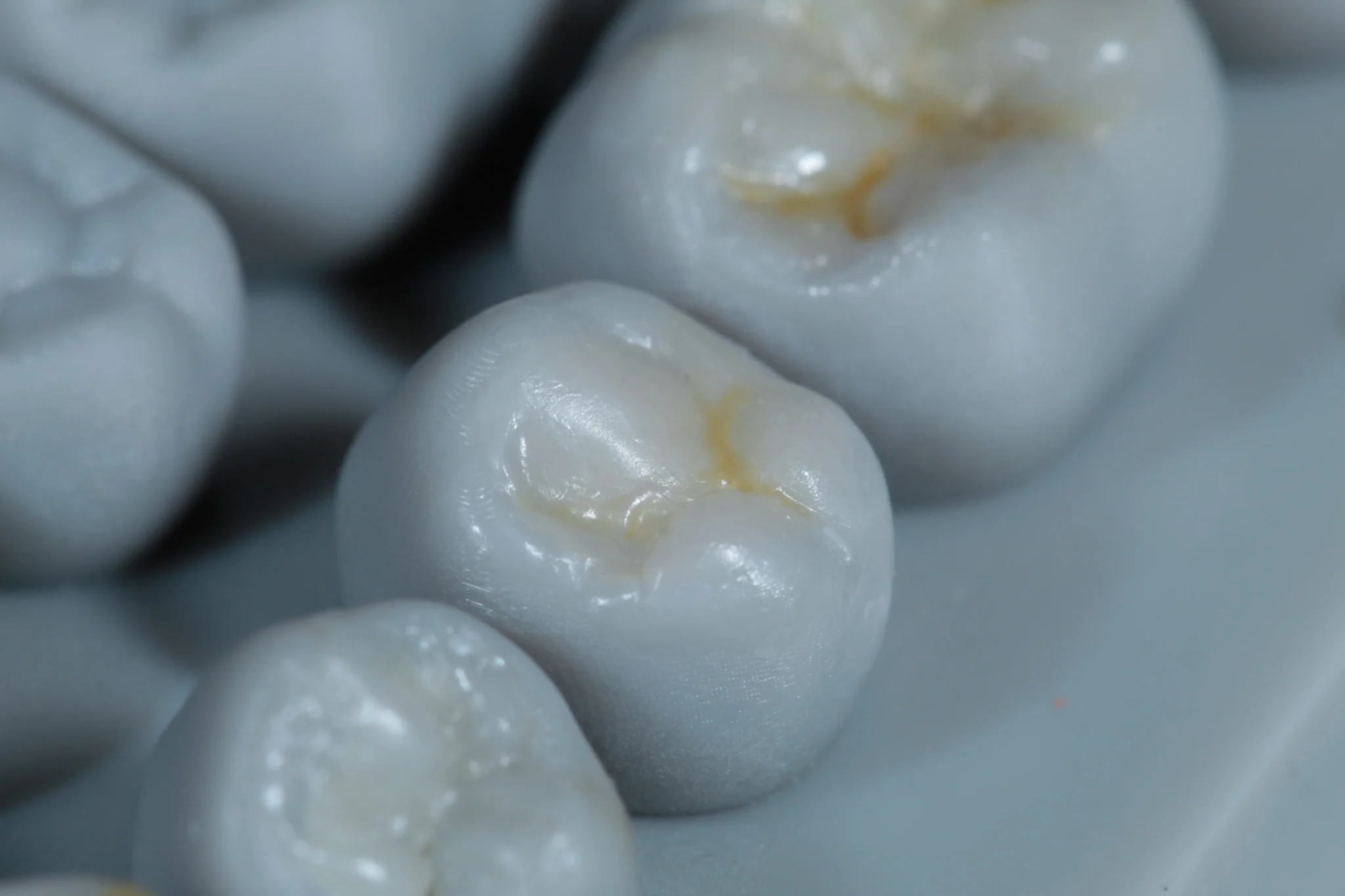 Modelado con resina dental - Dentista Veracruz