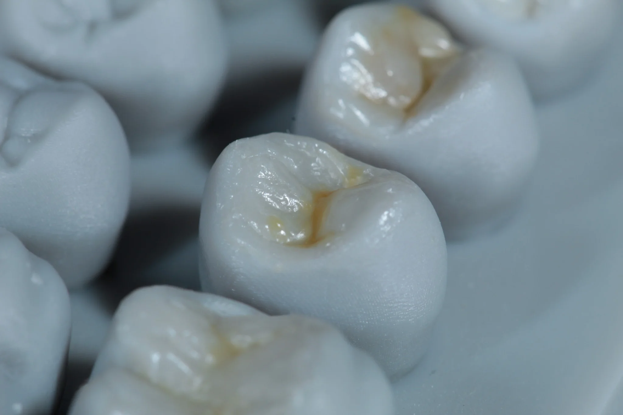 Modelado con resina dental - Dentista Veracruz