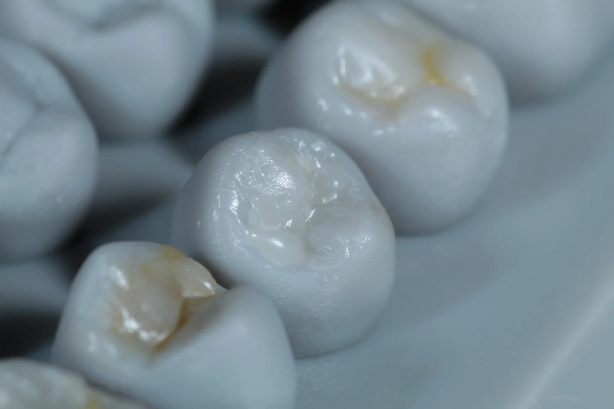 Modelado con resina dental - Dentista Veracruz